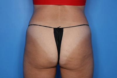Liposuction Before & After Gallery - Patient 376526 - Image 1