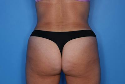Liposuction Before & After Gallery - Patient 376526 - Image 2