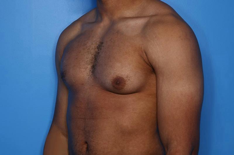 Gynecomastia (Male Breast Reduction) Before & After Gallery - Patient 248175 - Image 3