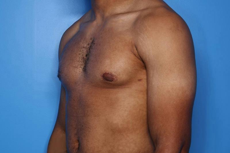 Gynecomastia (Male Breast Reduction) Before & After Gallery - Patient 248175 - Image 4