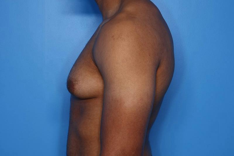Gynecomastia (Male Breast Reduction) Before & After Gallery - Patient 248175 - Image 5