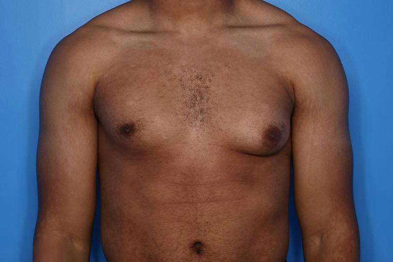Gynecomastia (Male Breast Reduction) Before & After Gallery - Patient 248175 - Image 1
