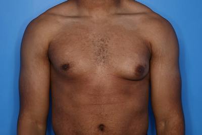 Gynecomastia (Male Breast Reduction) Before & After Gallery - Patient 248175 - Image 1