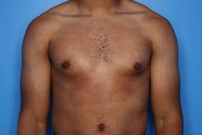 Gynecomastia (Male Breast Reduction) Before & After Gallery - Patient 248175 - Image 2