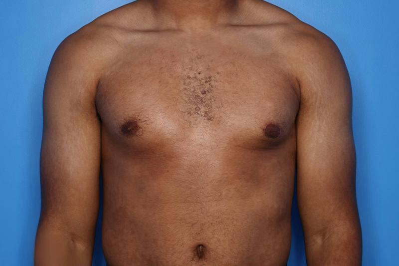 Gynecomastia (Male Breast Reduction) Before & After Gallery - Patient 248175 - Image 2