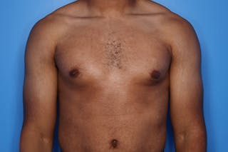 Gynecomastia (Male Breast Reduction) Before & After Gallery - Patient 248175 - Image 2