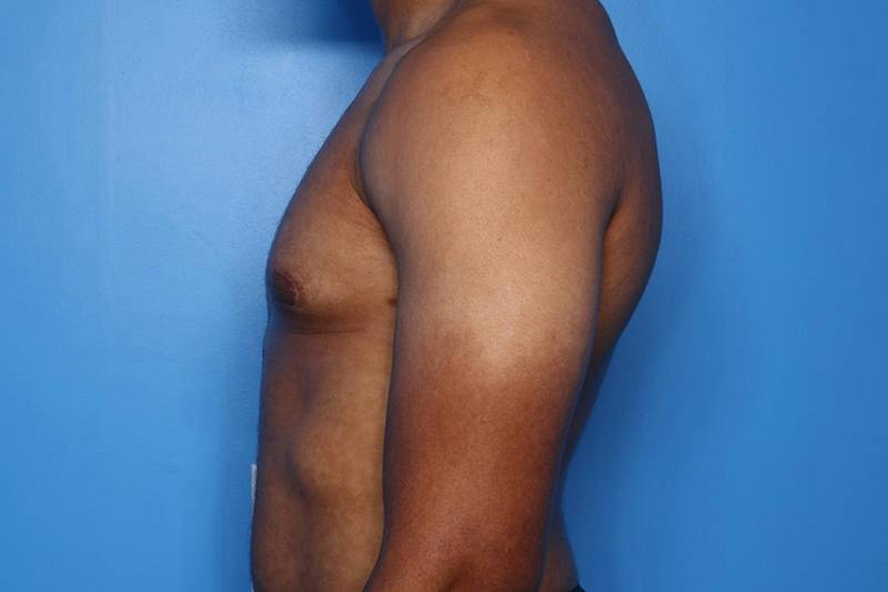 Gynecomastia (Male Breast Reduction) Before & After Gallery - Patient 248175 - Image 6