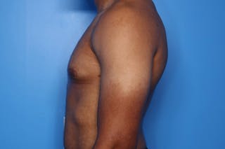 Gynecomastia (Male Breast Reduction) Before & After Gallery - Patient 248175 - Image 6