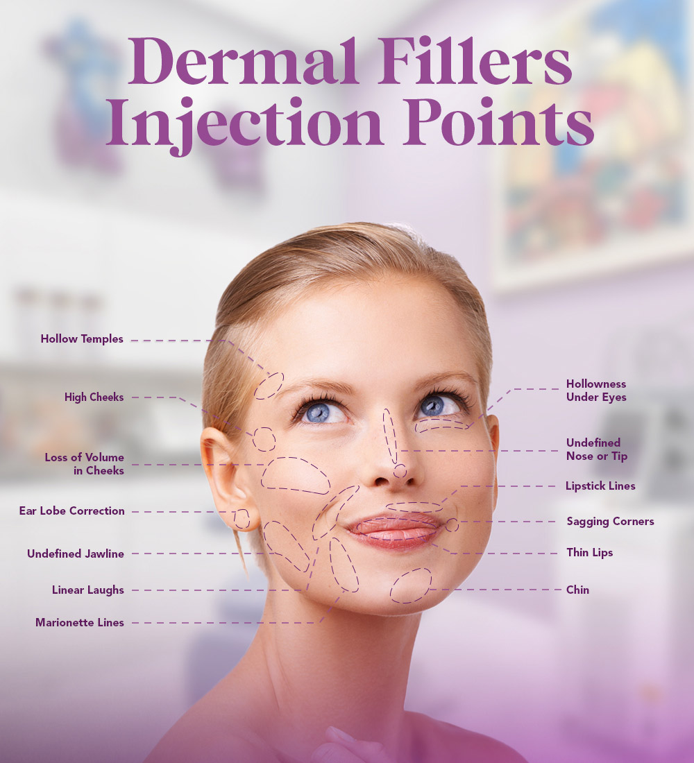 dermal fillers infographic