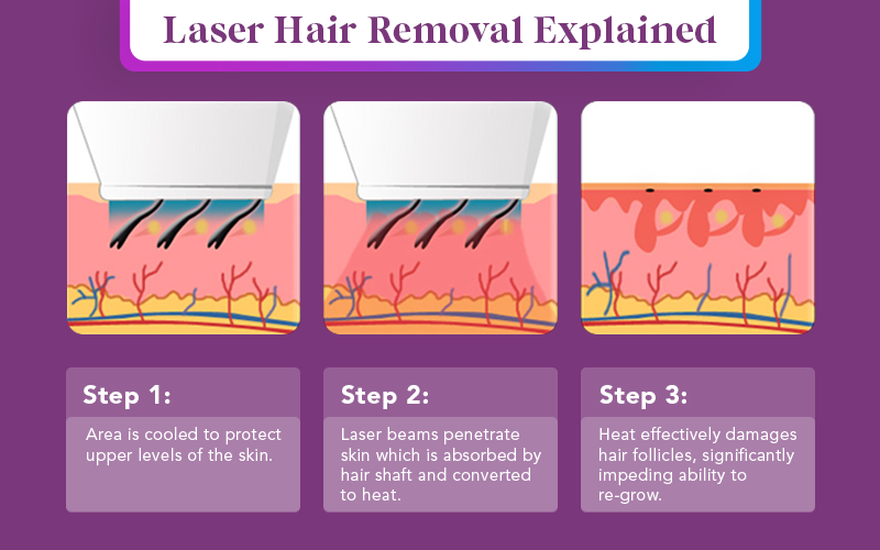 laser hair removal infrographic