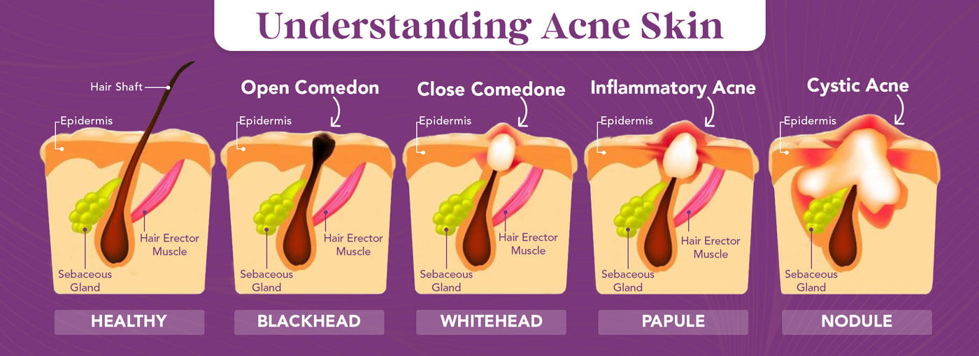 acne skin infographic