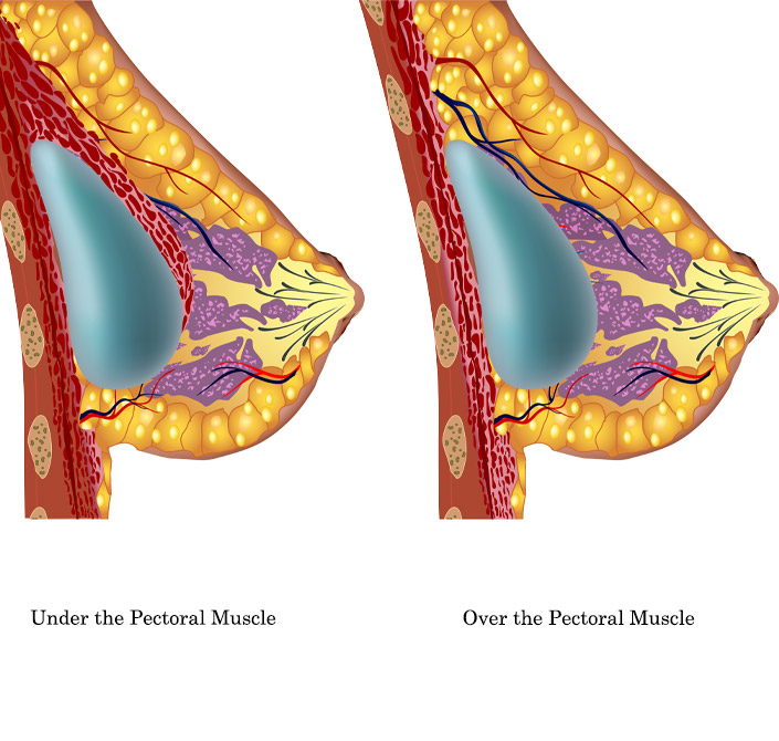 breast implant replacement graphic