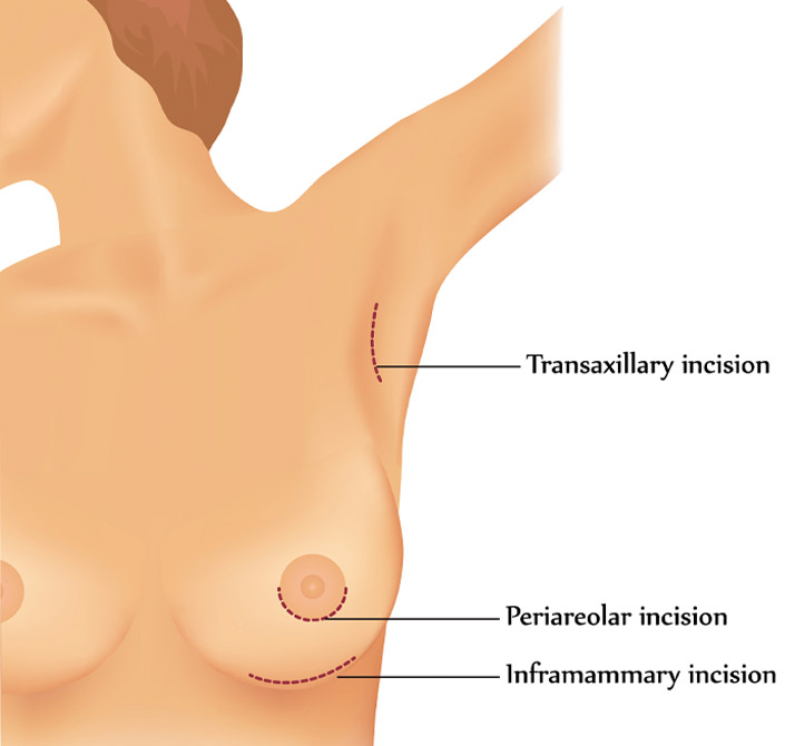 breast augmenation incision infographic