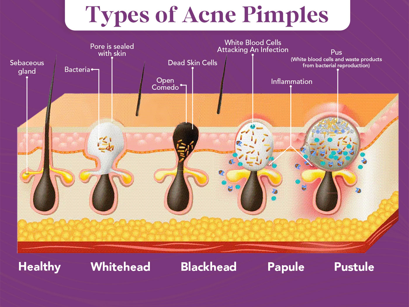 acne pimple infographic