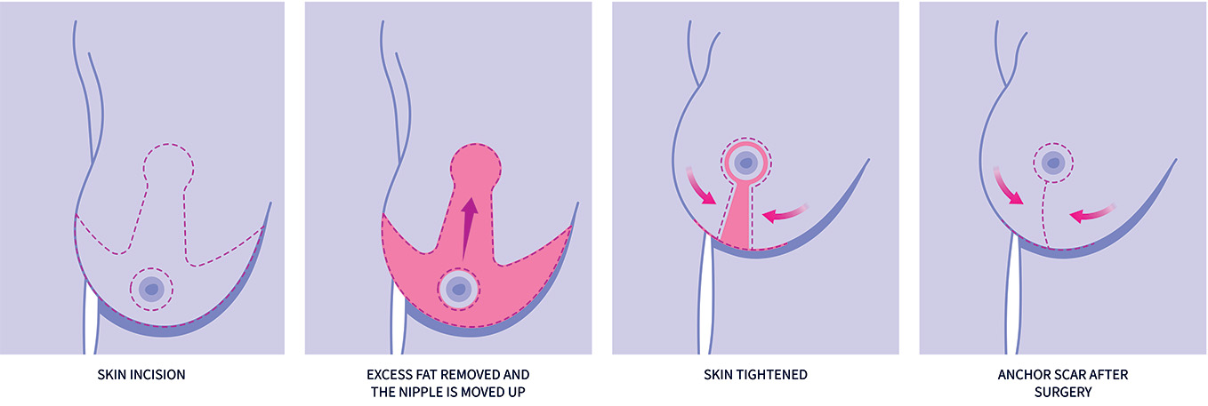 breast lift with implants infographic