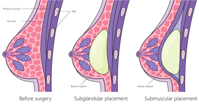 Subglandular vs SubmuscularBreast Implant Placement infographic