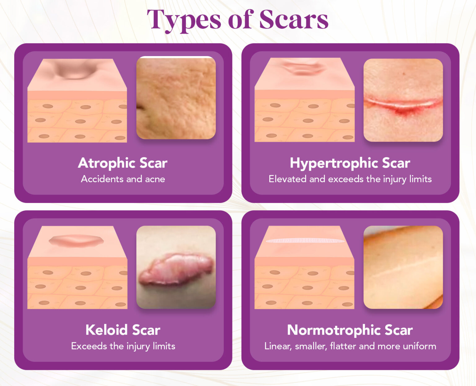 types of scars graphic