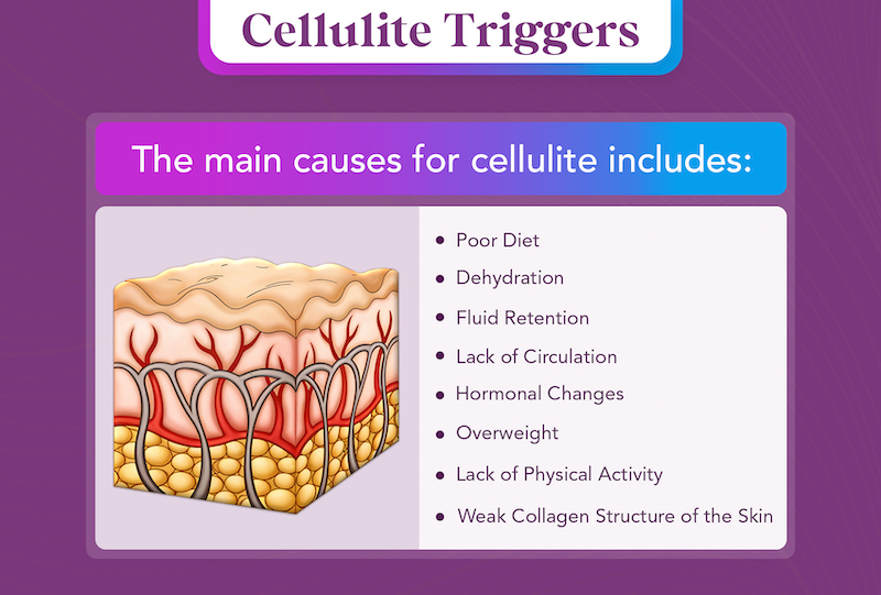 Cellulite Triggers inforgraphic