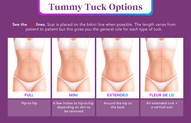 Tummy Tuck infographic