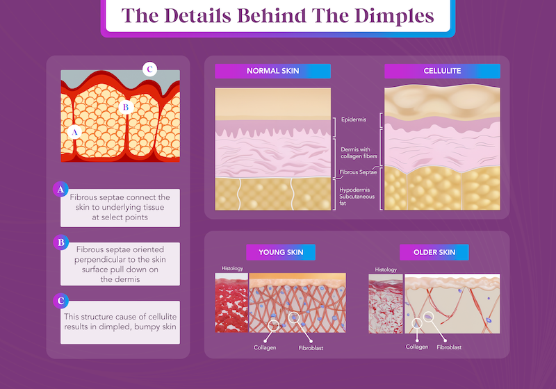 cellulite infographic