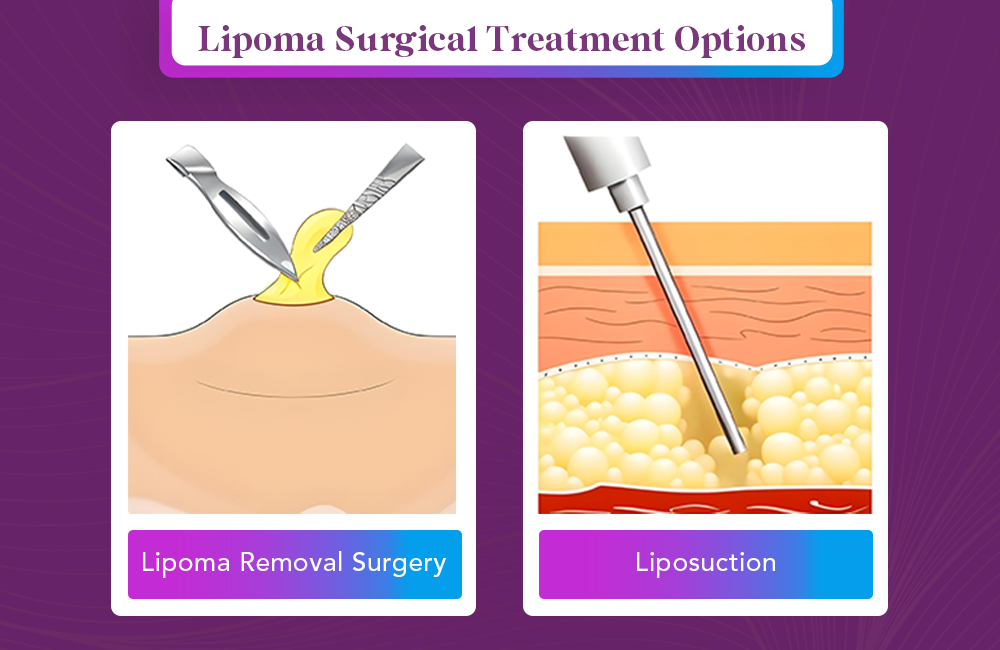 lipoma infographic