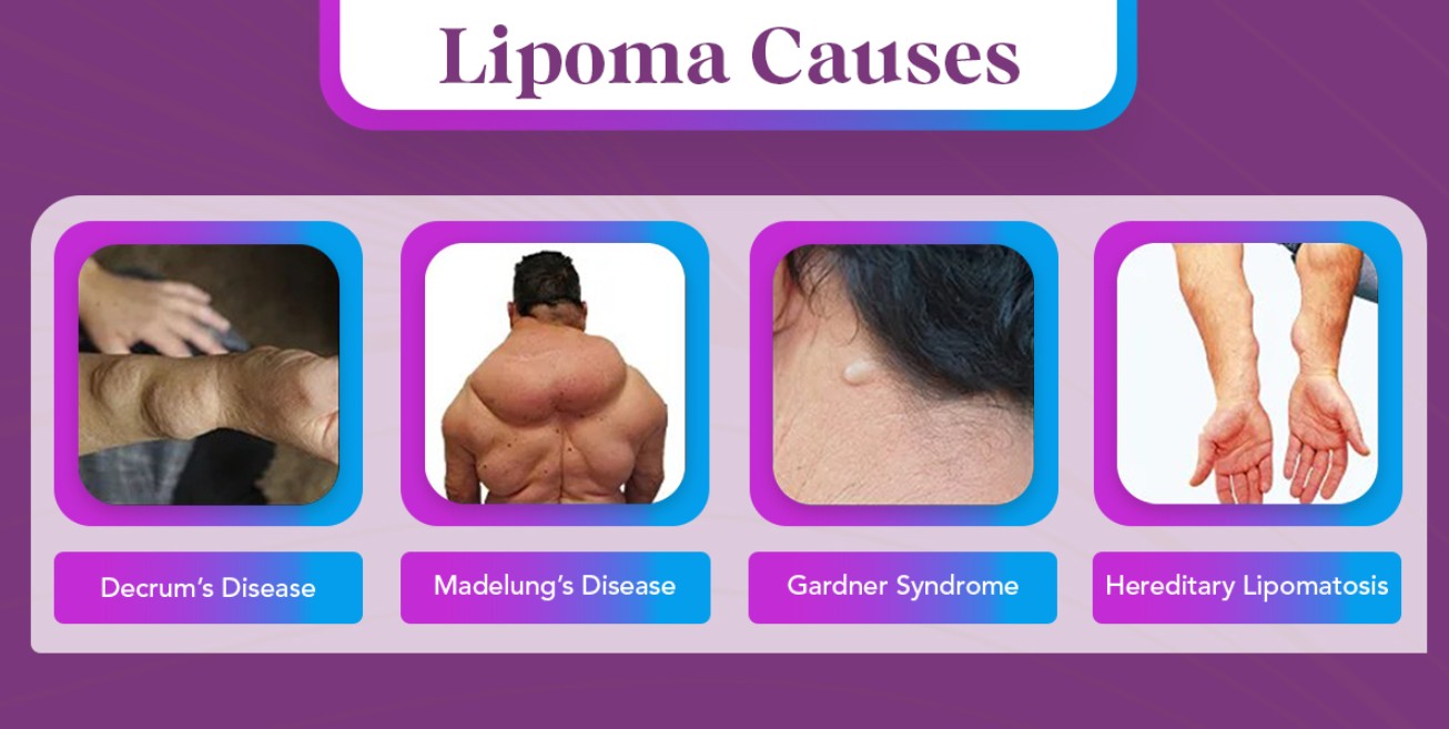 lipoma infographic
