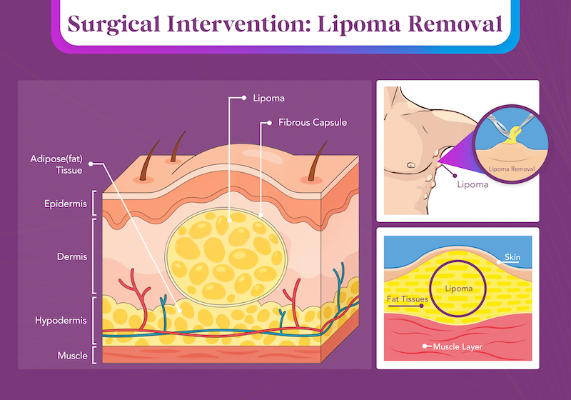 lipoma removal inforgraphic