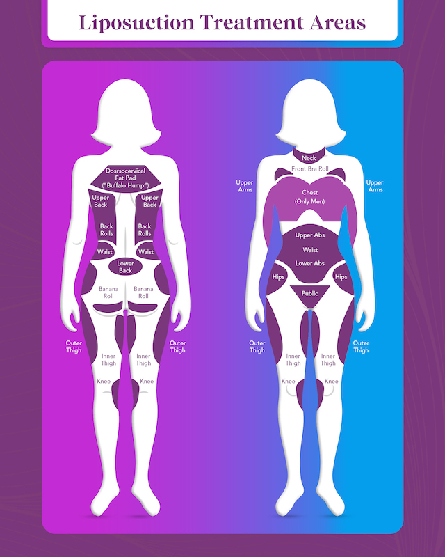liposuction infographic