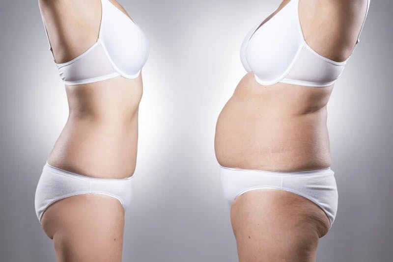 semaglutide gilbert Weight Loss Options in Gilbert: Unveiling Costs & Benefits of Semaglutide