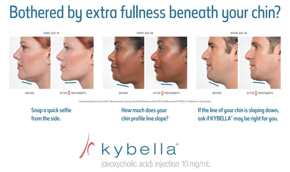kybella before and afters