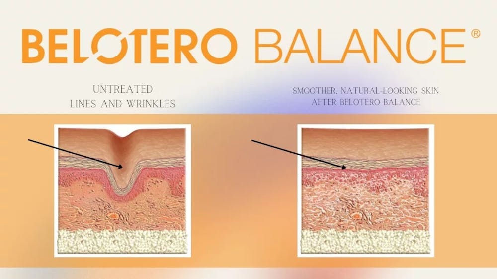 Belotero Balance infographic