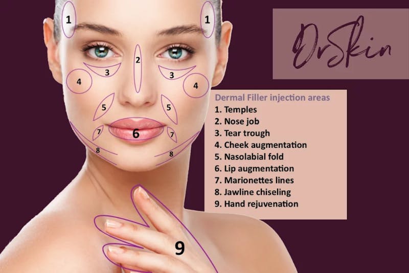 dermal filler infographic