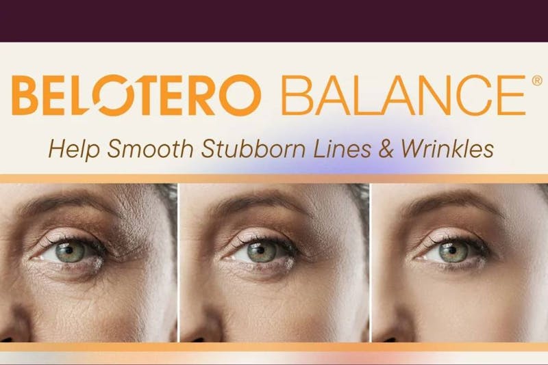Belotero Balance graphic