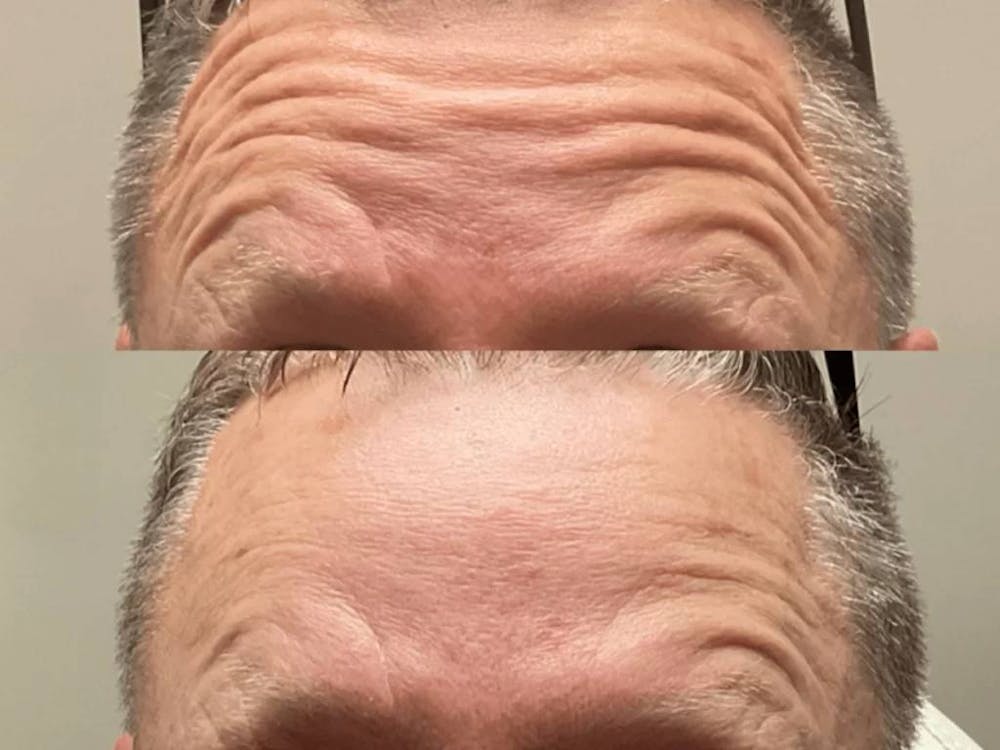 botox in forehead