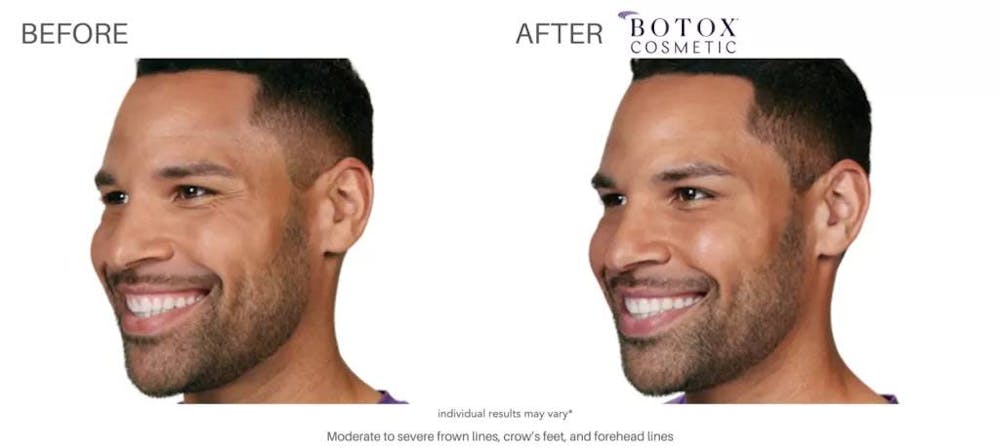 botox before and after