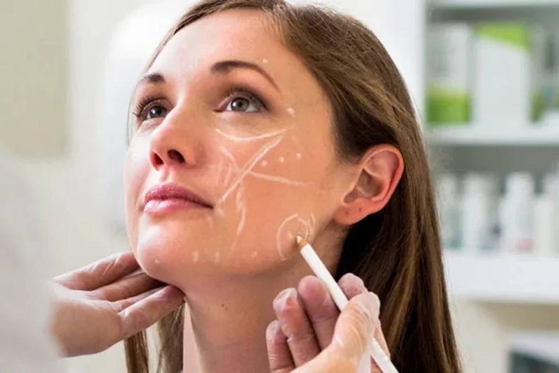 woman with injection siteplan on her face