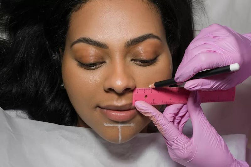 woman getting Juvederm Ultra XC treatment