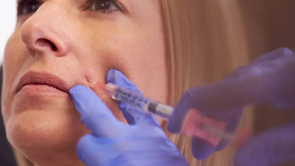 person getting juvederm injections