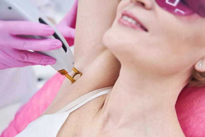 woman getting laser hair removal