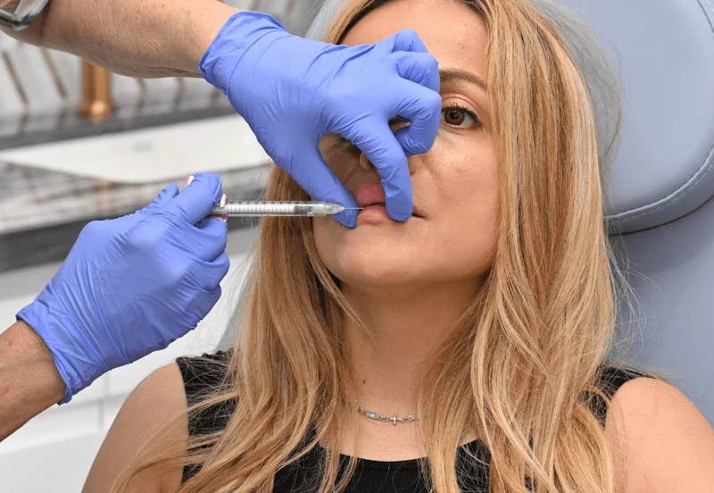 woman getting lip filler