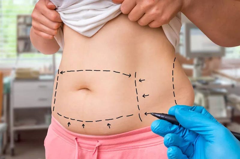 woman with surgical lines