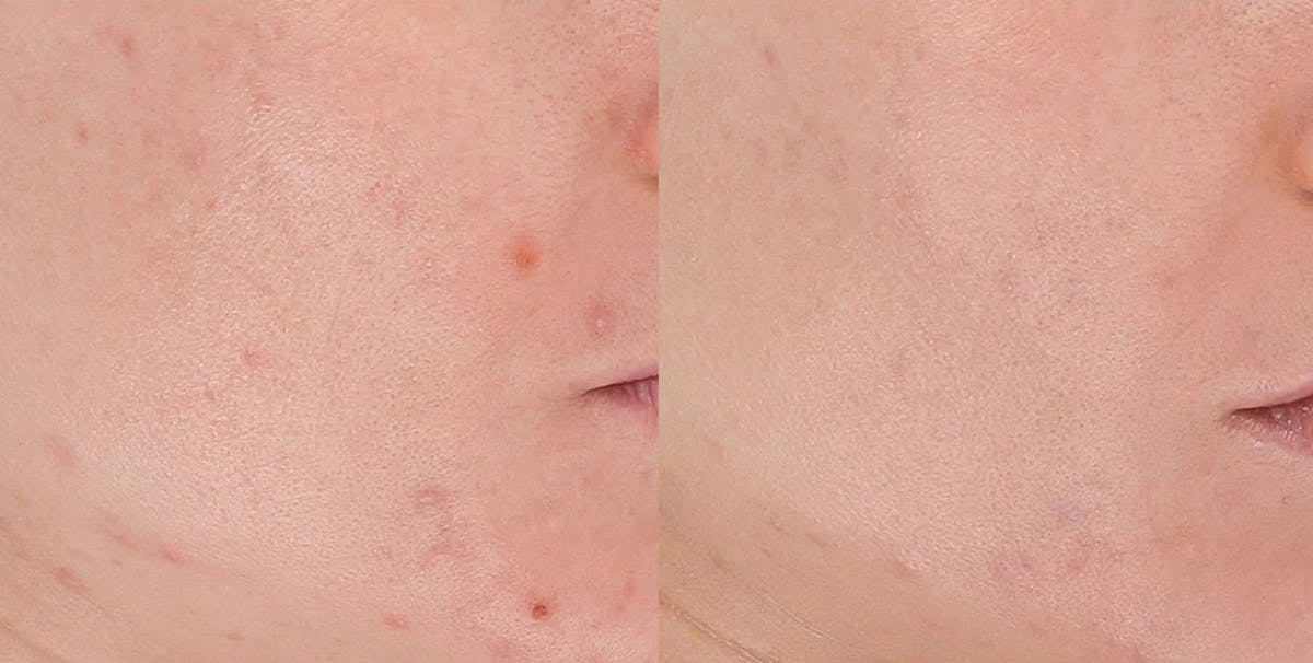 LightStim®  Before & After Gallery - Patient 221560 - Image 1