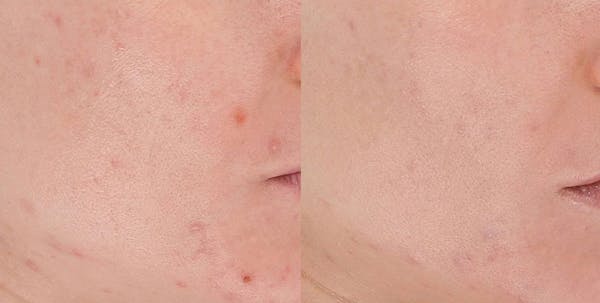 LightStim®  Before & After Gallery - Patient 221560 - Image 1