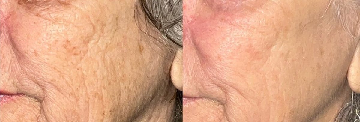 UltraClear® Before & After Gallery - Patient 314647 - Image 1