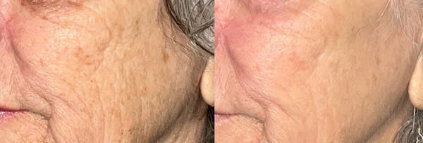 UltraClear® Before & After Gallery - Patient 314647 - Image 1