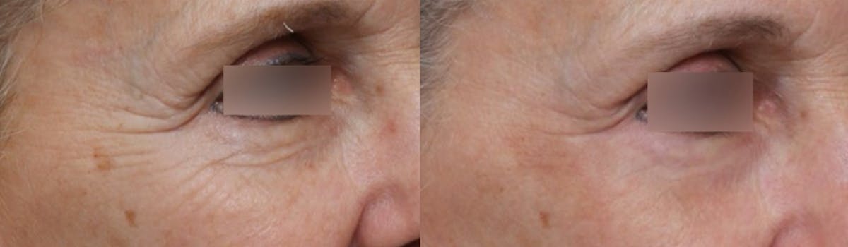 UltraClear® Before & After Gallery - Patient 299238 - Image 1