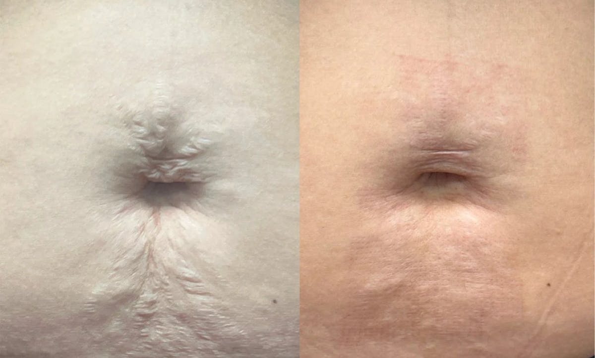 UltraClear® Before & After Gallery - Patient 305931 - Image 1