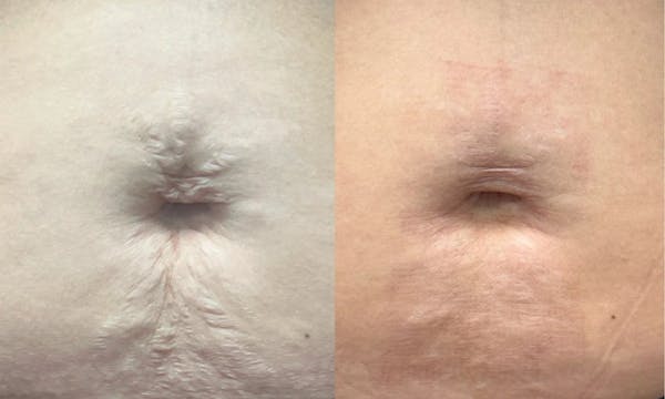 UltraClear® Before & After Gallery - Patient 305931 - Image 1
