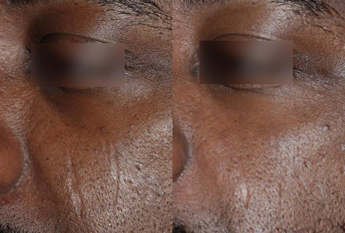 UltraClear® Before & After Gallery - Patient 275557 - Image 1