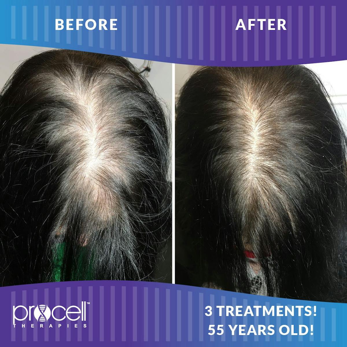 Procell Hair Restoration Before & After Gallery - Patient 397218 - Image 1